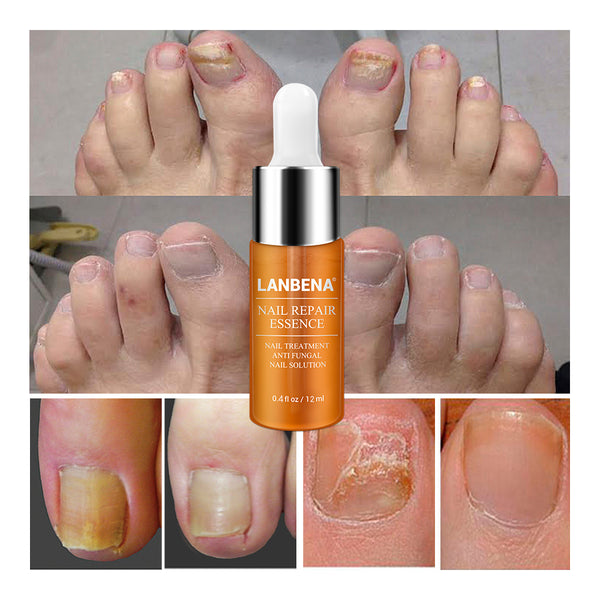 LANBENA Nail Repair Essence Serum Fungal Nail Treatment Remove Onychomycosis Hands and Feet Care of  Toe Nail Nourishing Brighte