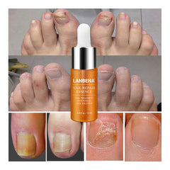LANBENA Nail Repair Essence Serum Fungal Nail Treatment Remove Onychomycosis Hands and Feet Care of  Toe Nail Nourishing Brighte